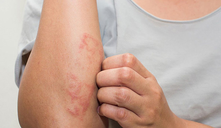 Các bệnh ngoài da thường gặp khi thời tiết chuyển mùa và cách điều trị